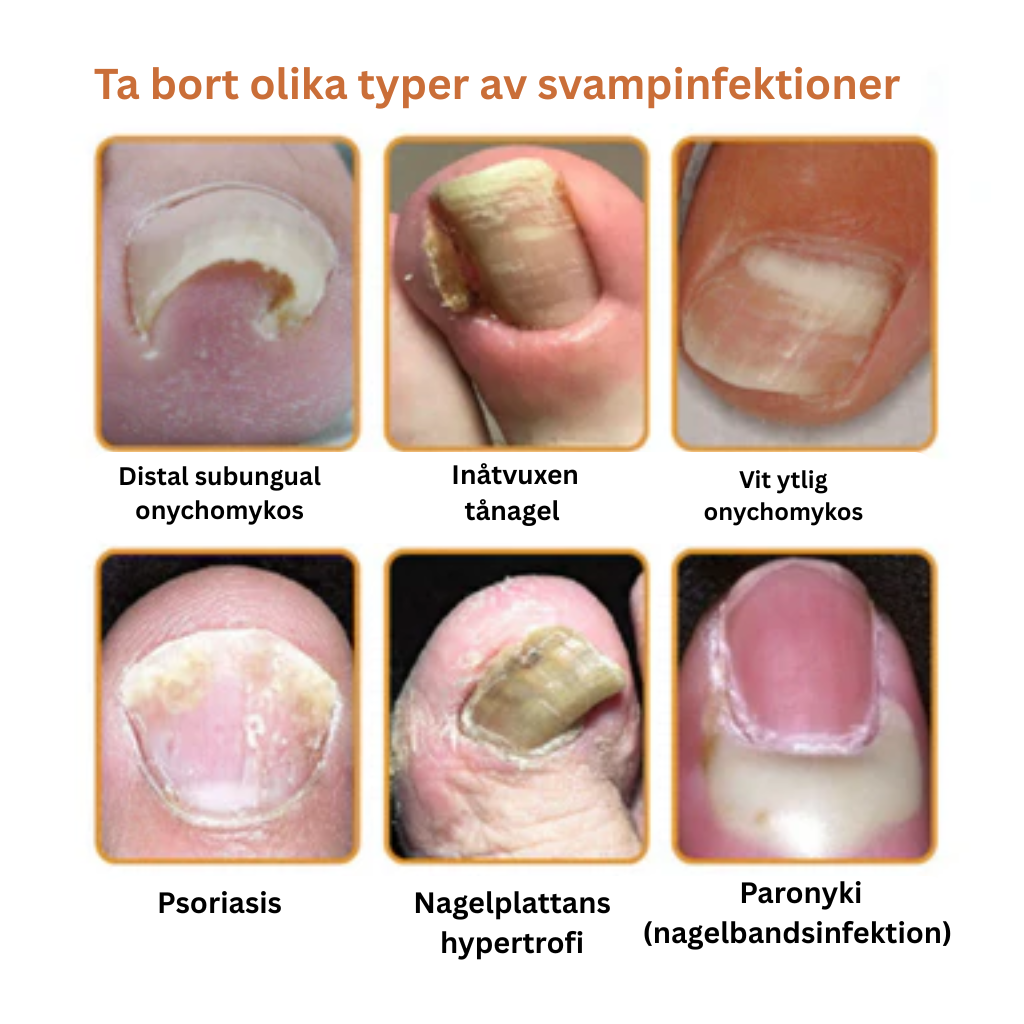 PropoFix™ - Avancerad svampbekämpande nagelspray