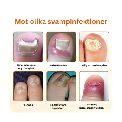 PropoFix™ - Avancerad svampbekämpande nagelspray