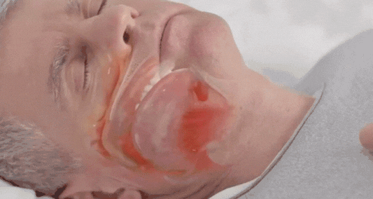 SnarkStop™ | Fri andning, fri sömn 1 + 1