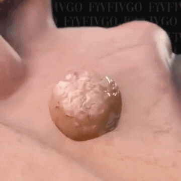 StopWrat™ - Vårtförslutningsplåster