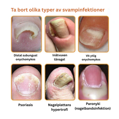 PropoFix™ - Avancerad svampbekämpande nagelspray